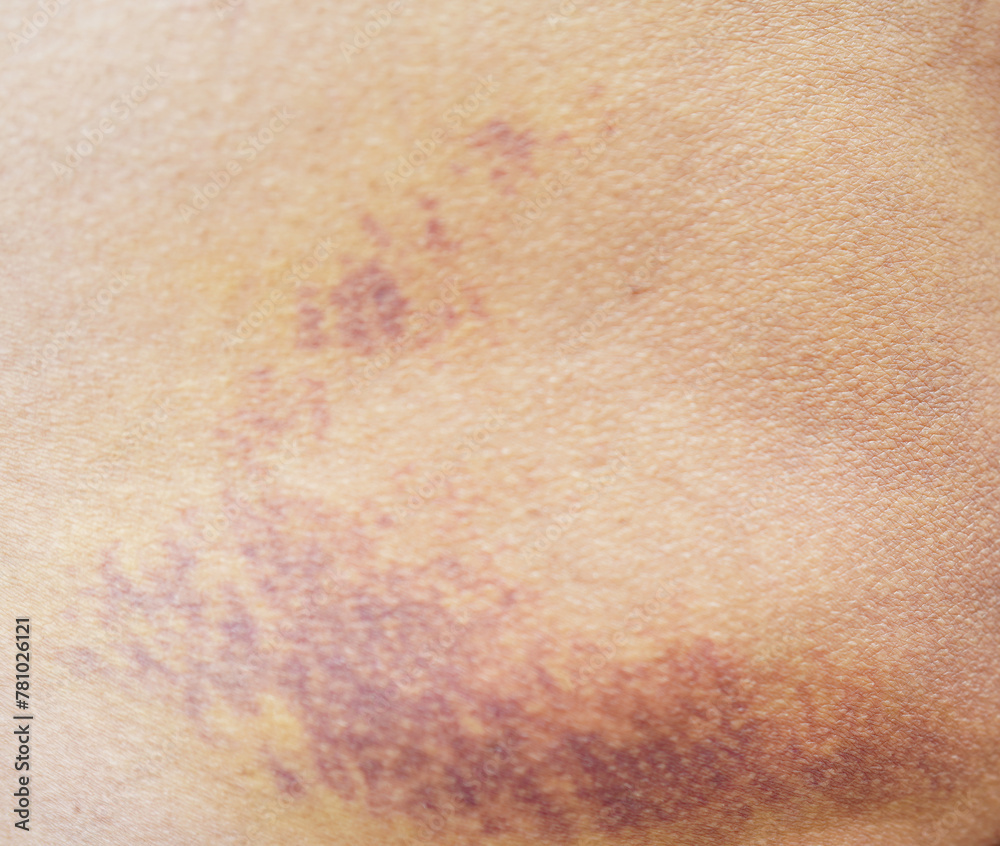 Fototapeta premium Bruise on the buttock skin injury from accident at home.