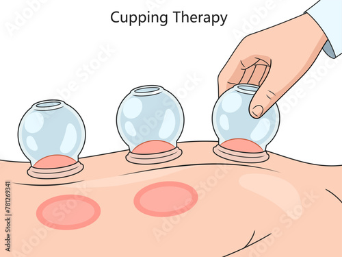 cupping therapy on skin, showcasing suction technique and resulting skin reaction diagram hand drawn schematic vector illustration. Medical science educational illustration