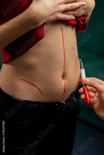 close up in a plastic surgery clinic doctor makes markings on the stomach of a young girl before surgery