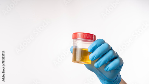 Doctor holds a plastic container for analysis with the collected urine of the patient, a concept check-up of the human body, early detection of diseases. Urine in a container.