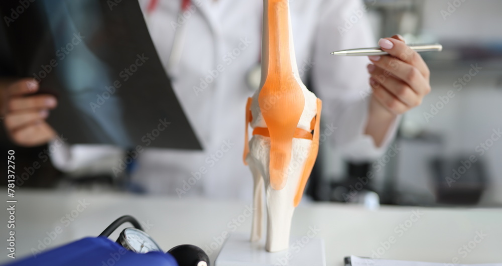 Doctor shows anatomy of knee joint and x-ray. Arthrosis of knee joint or gonarthrosis concept