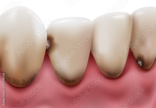 The lower teeth have tartar and plaque. Causes bad breath and tooth decay. Realistic illustration vector file.