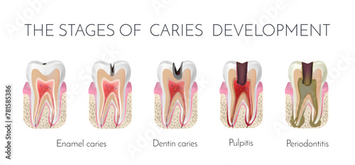 Tooth decay. The stages of caries development. Enamel and dentin caries, pulpits and periodontitis medical raster copy photo