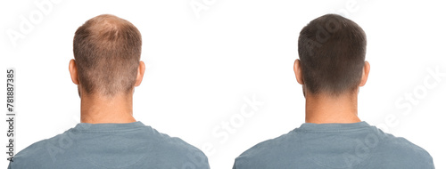 Man before and after hair treatment with high frequency darsonval device on white background, back view. Collage of photos photo
