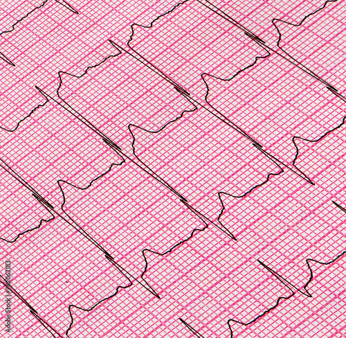 A fragment of a cardiogram. Cardiological examination