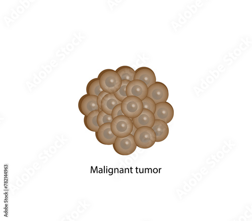 Malignant tumor. Cancer disease development. Medical biological, science vector illustration.	