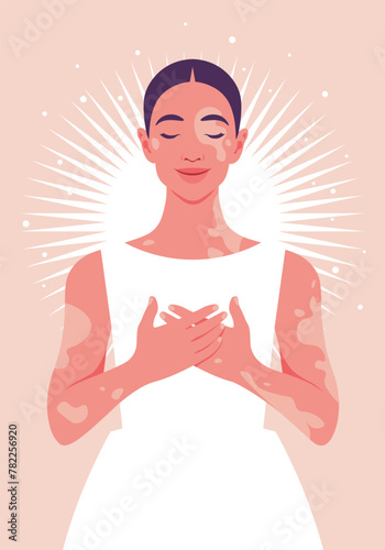 A young woman with vitiligo. Body positive. Self-love and acceptance. Body positive. Vector flat illustration