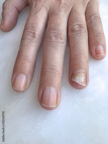 broken fingernail with infection