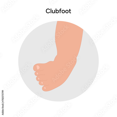 Clubfoot problem foot. Orthopedic infographic diagram