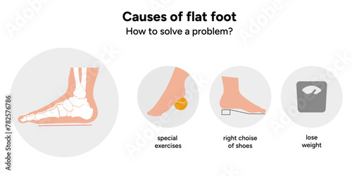 Causes of flat foot photo