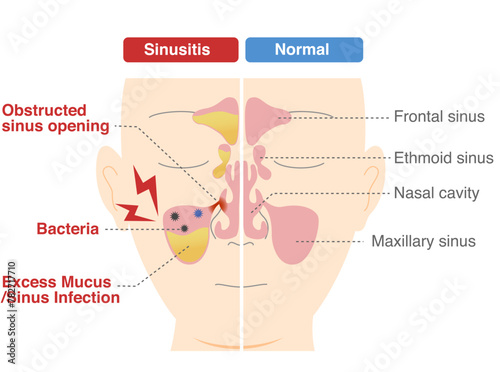 Comparative chart of how and why chronic sinusitis occurs