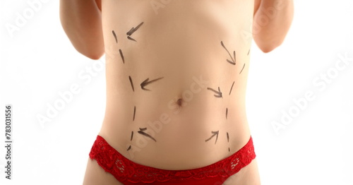 Female body stomach with markup before liposuction shaping surgery for surgeon concept closeup