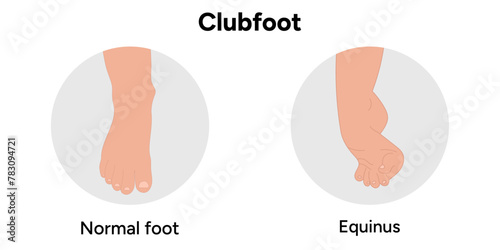 Normal and Equinus Clubfoot problem foot. Orthopedic infographic diagram