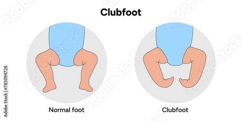 Clubfoot in baby’s 