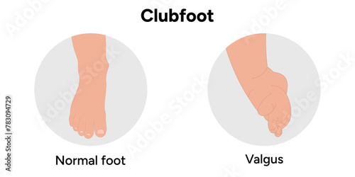 Normal and Valgus Clubfoot problem foot. Orthopedic infographic diagram