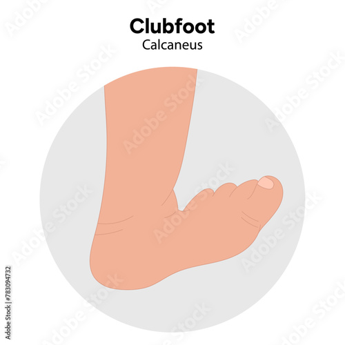 Calcaneus Clubfoot problem foot. Orthopedic infographic diagram