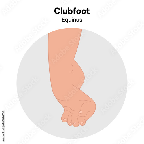 Equinus Clubfoot problem foot. Orthopedic infographic diagram
