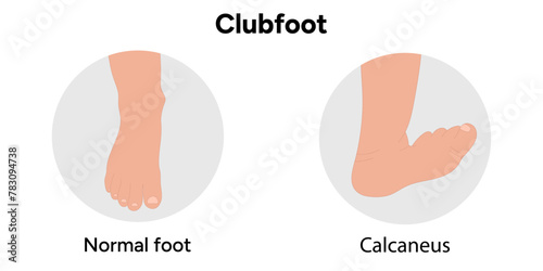 Normal and Calcaneus Clubfoot problem foot. Orthopedic infographic diagram