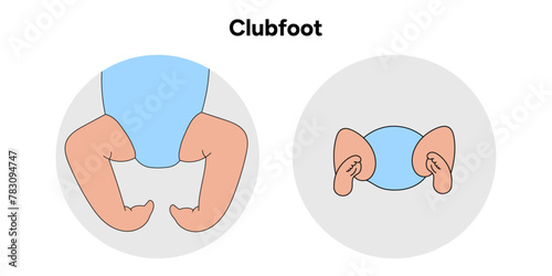 Clubfoot in baby’s 