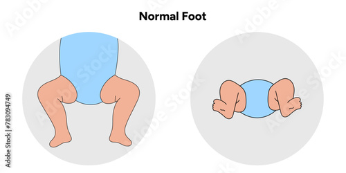 Normal foot in children. Orthopedic infographic diagram