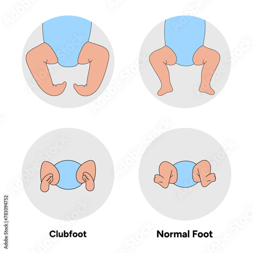 Normal and Clubfoot problem foot in children. Orthopedic infographic diagram