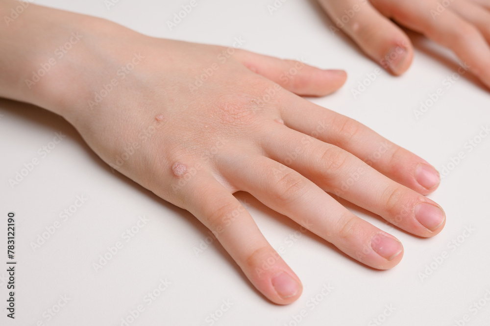 Child hand with common viral warts Verruca vulgaris - flat warts, close-up. Human papillomavirus HPV. Pediatric dermatology concept. Child hand with common viral warts Verruca vulgaris - flat warts, close-up. Human papillomavirus HPV. Pediatric dermatology concept.