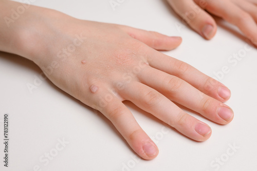 Child hand with common viral warts Verruca vulgaris - flat warts  close-up. Human papillomavirus HPV. Pediatric dermatology concept.