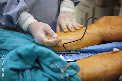 Process of varicose vein surgery in hospital, vein sealing, venous vascular surgery, phlebectomy surgery, surgical field marking, superficial veins problems, swollen skin, step by step photo