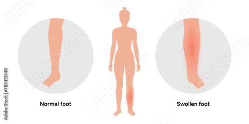 Edema swollen foot and normal foot