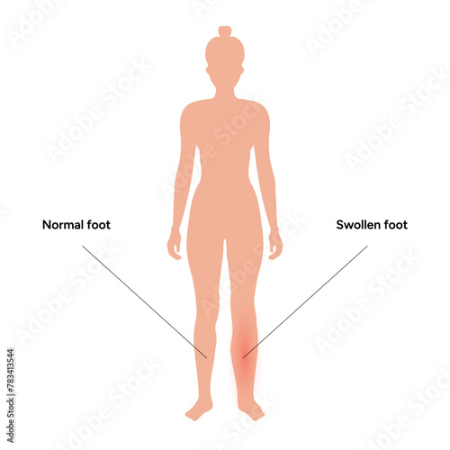 Edema swollen foot and normal foot