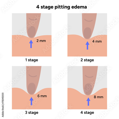Edema swollen foot, medical infographic, 4 stages of edema