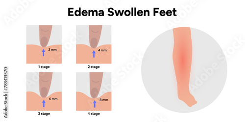 Edema swollen feet