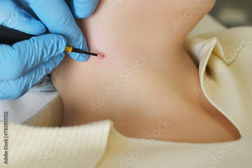 surgeon uses a radio wave knife to remove a neoplasm - a mole or nevus on the neck of a female patient.