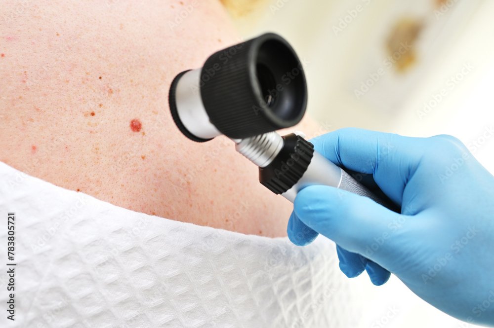 a dermatologist examines moles and skin growths on the patient's body using a special device - a dermatoscope. Diagnosis and prevention of melanoma. - obrazy, fototapety, plakaty 