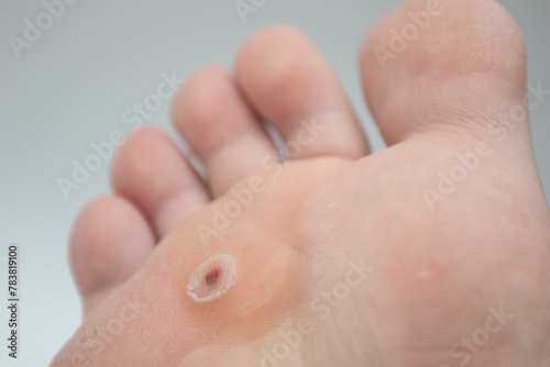 Toe wart. Foot with wart on a toe. Wart verrucas plantar