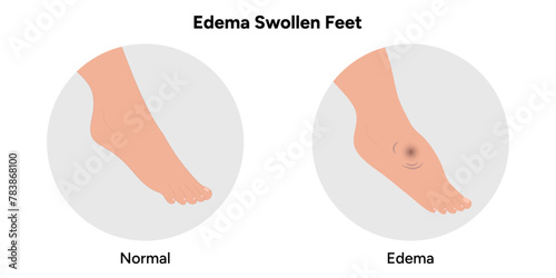 Normal and swollen edema foot 