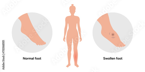 Normal and swollen edema foot 