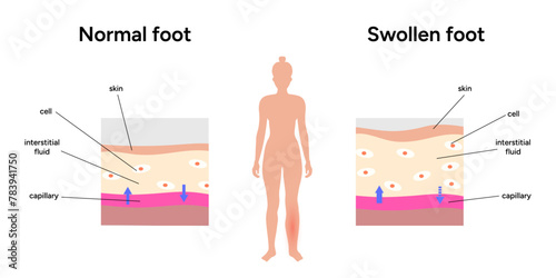 Normal and swollen edema, medical infographic 