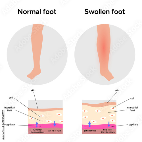 Normal and swollen edema, medical infographic 