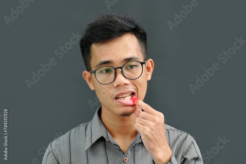 Asian man has aphthous boils on his lips. photo