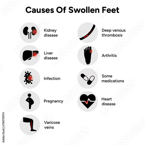 Causes of swollen feet. Orthopedist diagram and infographic