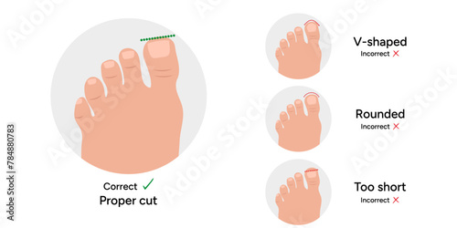 Ingrown toenail  disease, correct and incorrect toenail form  photo