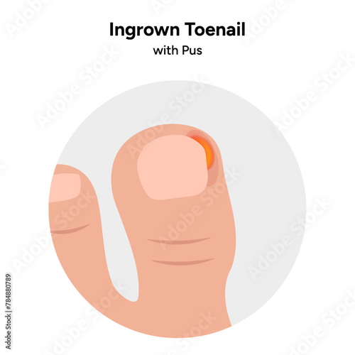 Ingrown toenail  disease or infection with pus