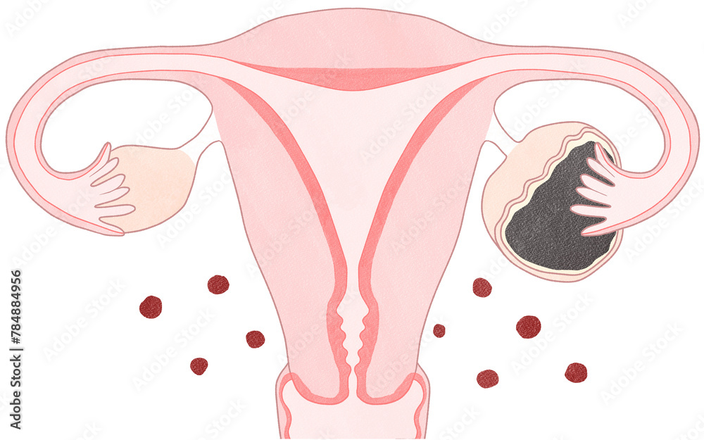 Blank endometriosis Unlabeled diagram transparent PNG