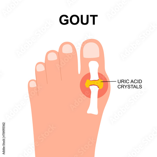 Gout arthritis with Uric acid crystals. Human foot in flat design.
