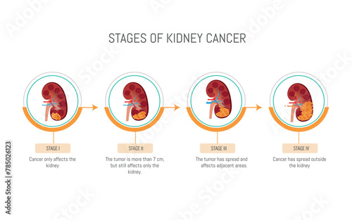 A diagram of the stages of kidney cancer. The stages are: Stage I, Stage II, Stage III, Stage IV, and Stage V
