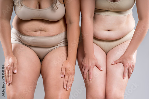 Tummy tuck, two fat women with cellulitis and flabby bellies on gray background, obese female body, plastic surgery and liposuction concept photo