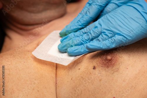 Manos de sanitario  poniendo en herida infectada en el abdomen de un hombre portador de un puerto venoso