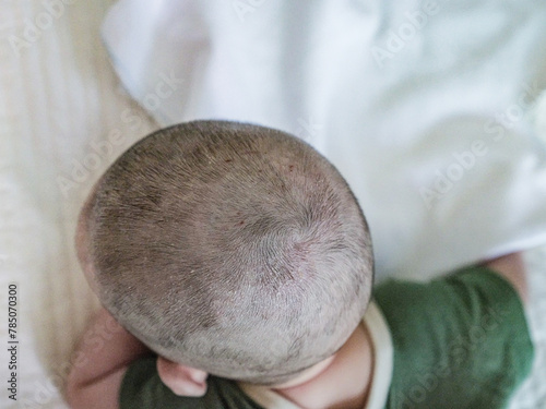 Baby Scalp Rash – Infant Skin Irritation and Redness on Head