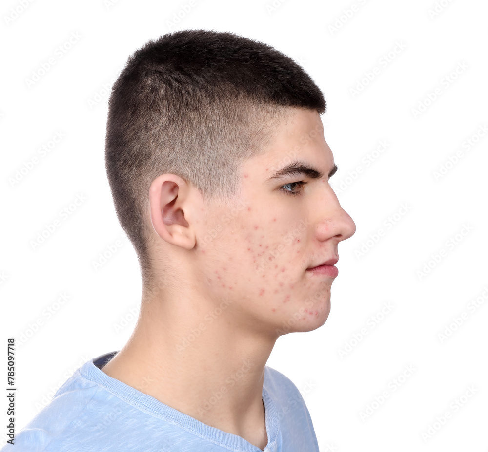 Young man with acne problem isolated on white Young man with acne problem isolated on white